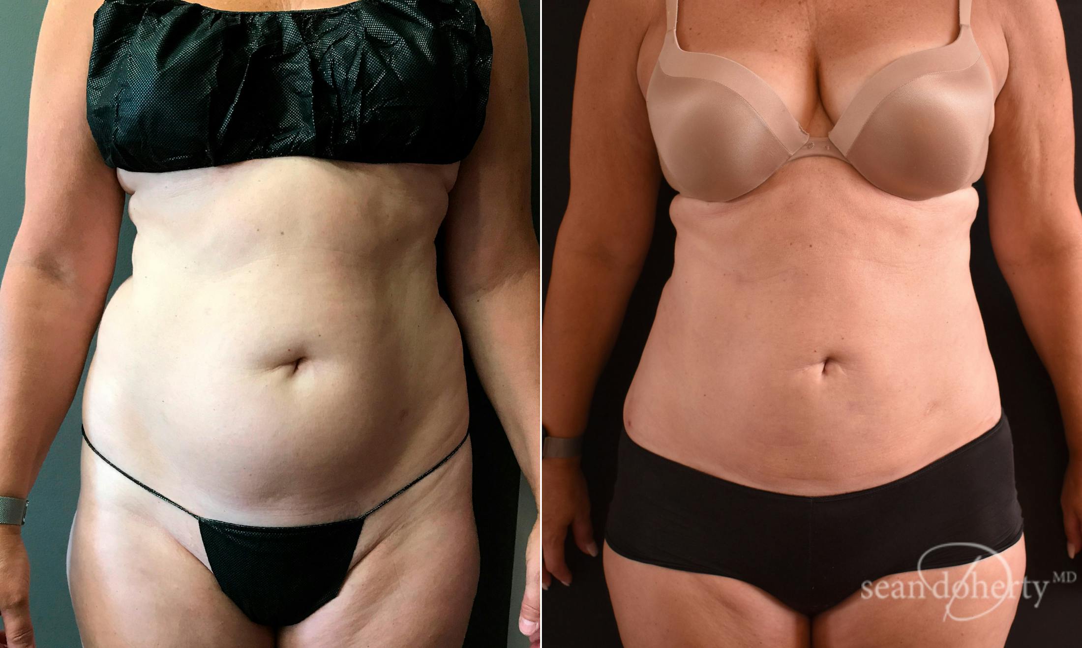 Liposuction and Fat Transfer Before & After Gallery - Patient 234277 - Image 1