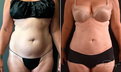 Liposuction and Fat Transfer Before & After Gallery - Patient 234277 - Image 1