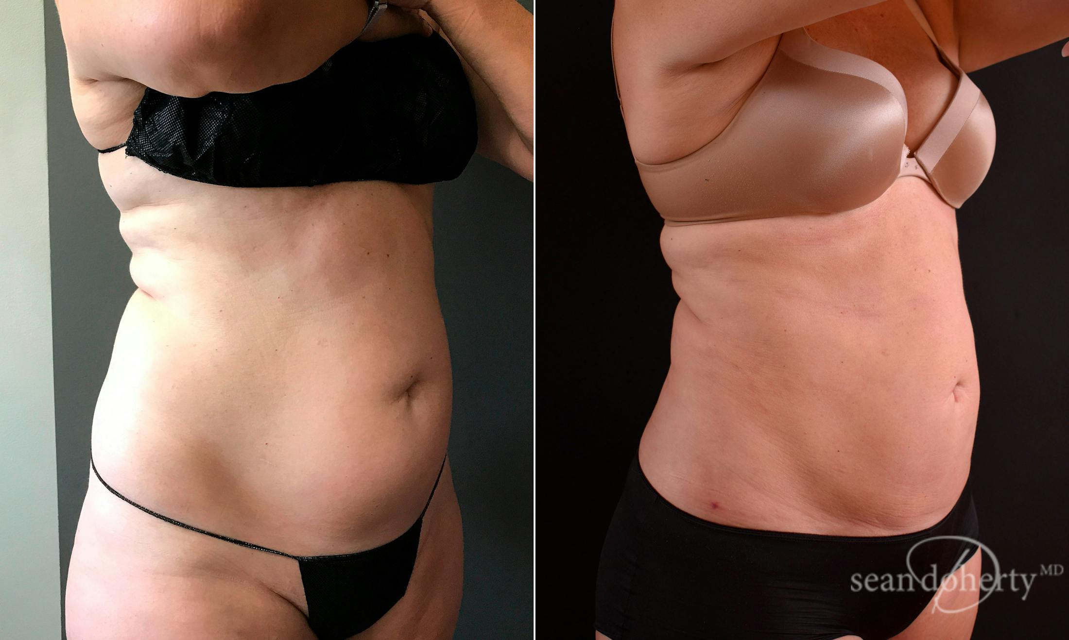 Liposuction and Fat Transfer Before & After Gallery - Patient 234277 - Image 2