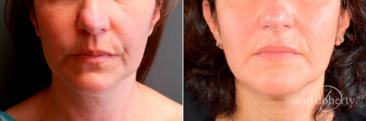 Liposuction and Fat Transfer Before & After Gallery - Patient 403726 - Image 1