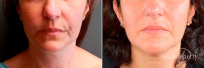 Liposuction and Fat Transfer Before & After Gallery - Patient 403726 - Image 1