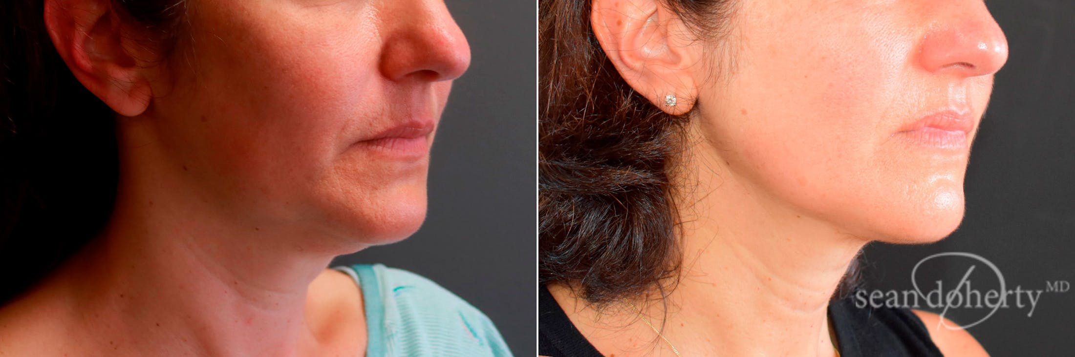 Liposuction and Fat Transfer Before & After Gallery - Patient 403726 - Image 2