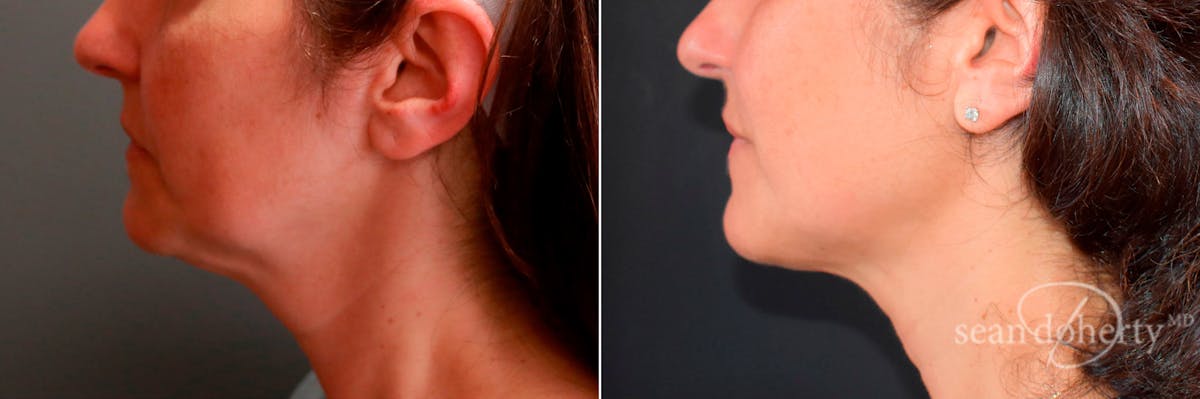 Liposuction and Fat Transfer Before & After Gallery - Patient 403726 - Image 3