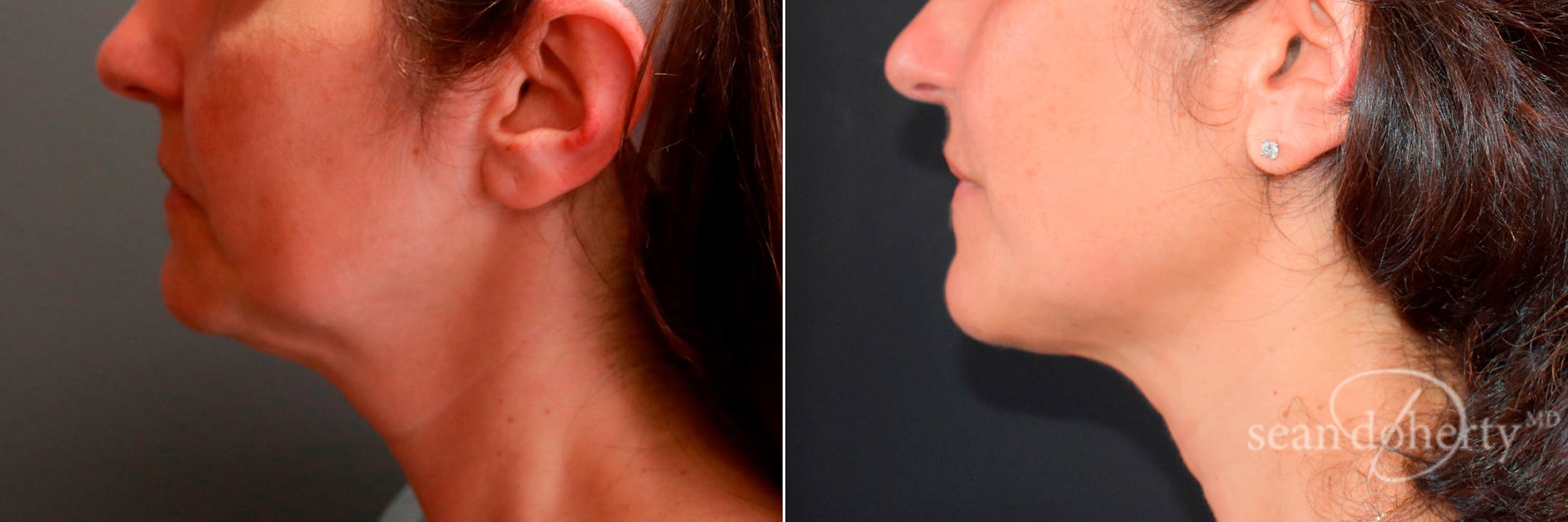 Liposuction and Fat Transfer Before & After Gallery - Patient 403726 - Image 3