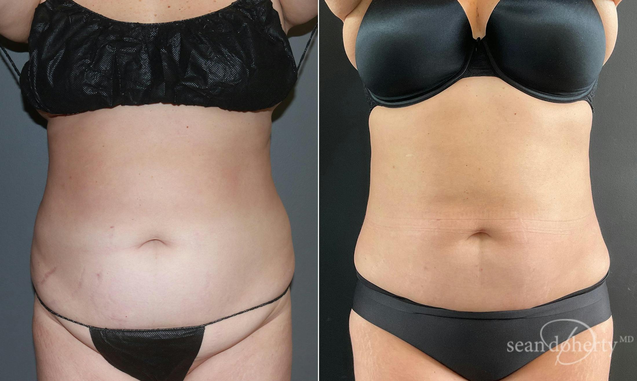 Liposuction and Fat Transfer Before & After Gallery - Patient 101382 - Image 1