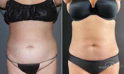 Liposuction and Fat Transfer Before & After Gallery - Patient 101382 - Image 1