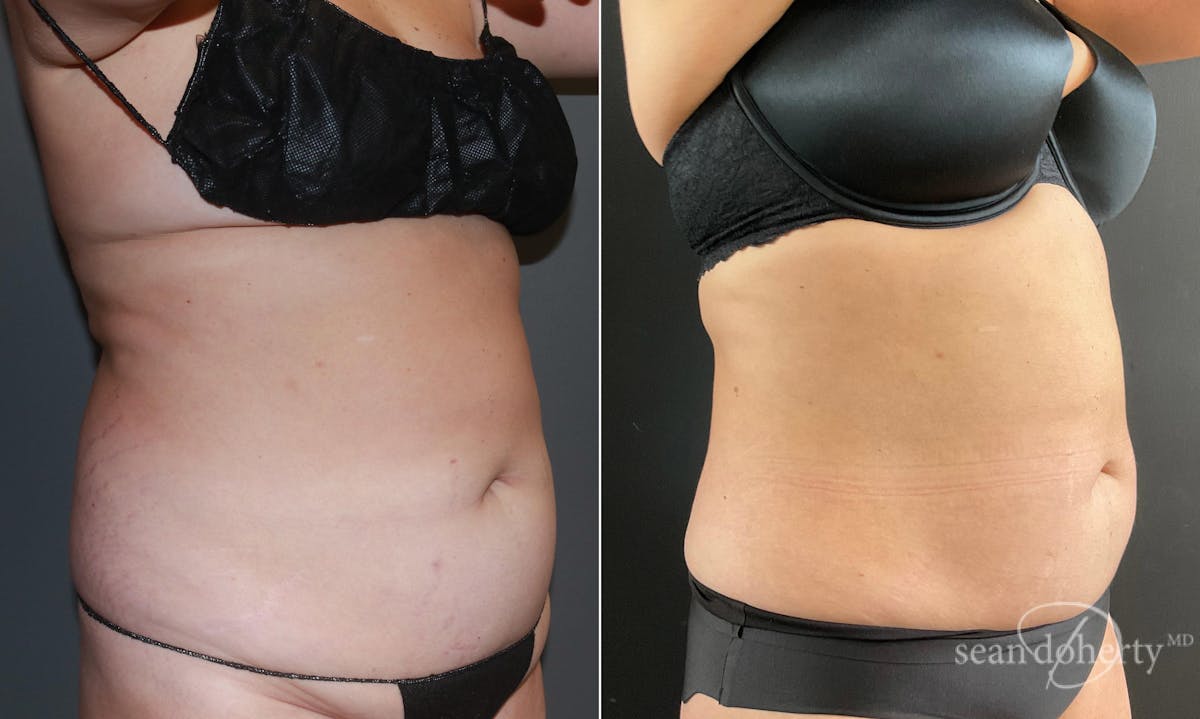 Liposuction and Fat Transfer Before & After Gallery - Patient 101382 - Image 2