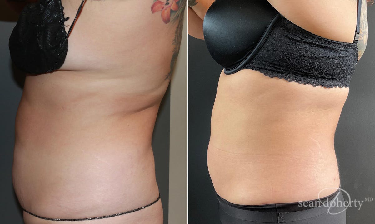 Liposuction and Fat Transfer Before & After Gallery - Patient 101382 - Image 3