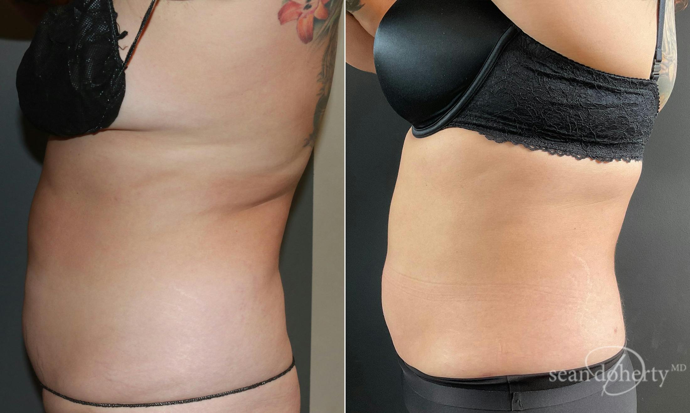 Liposuction and Fat Transfer Before & After Gallery - Patient 101382 - Image 3