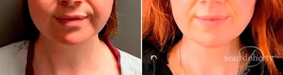 Liposuction and Fat Transfer Before & After Gallery - Patient 237901 - Image 1