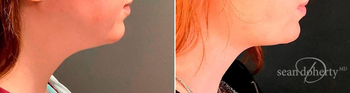 Liposuction and Fat Transfer Before & After Gallery - Patient 237901 - Image 3