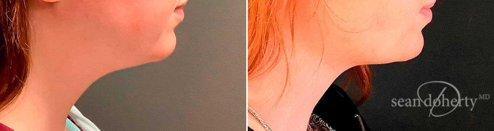 Liposuction and Fat Transfer Before & After Gallery - Patient 237901 - Image 3