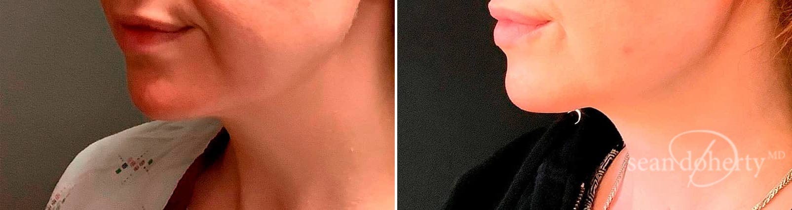 Liposuction and Fat Transfer Before & After Gallery - Patient 237901 - Image 2