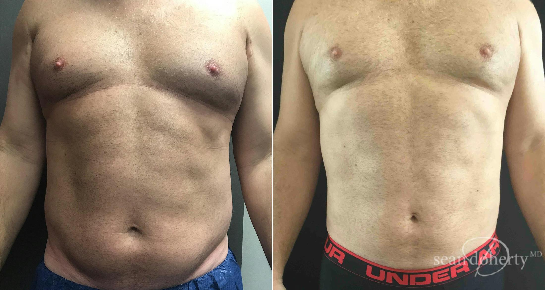 Liposuction and Fat Transfer Before & After Gallery - Patient 291161 - Image 1