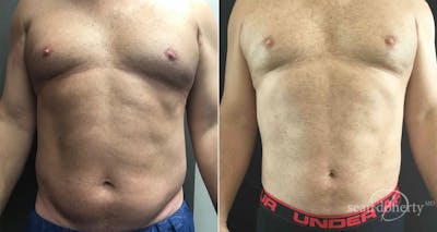 Liposuction and Fat Transfer Before & After Gallery - Patient 291161 - Image 1