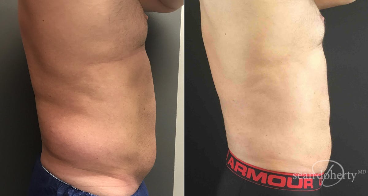 Liposuction and Fat Transfer Before & After Gallery - Patient 291161 - Image 3