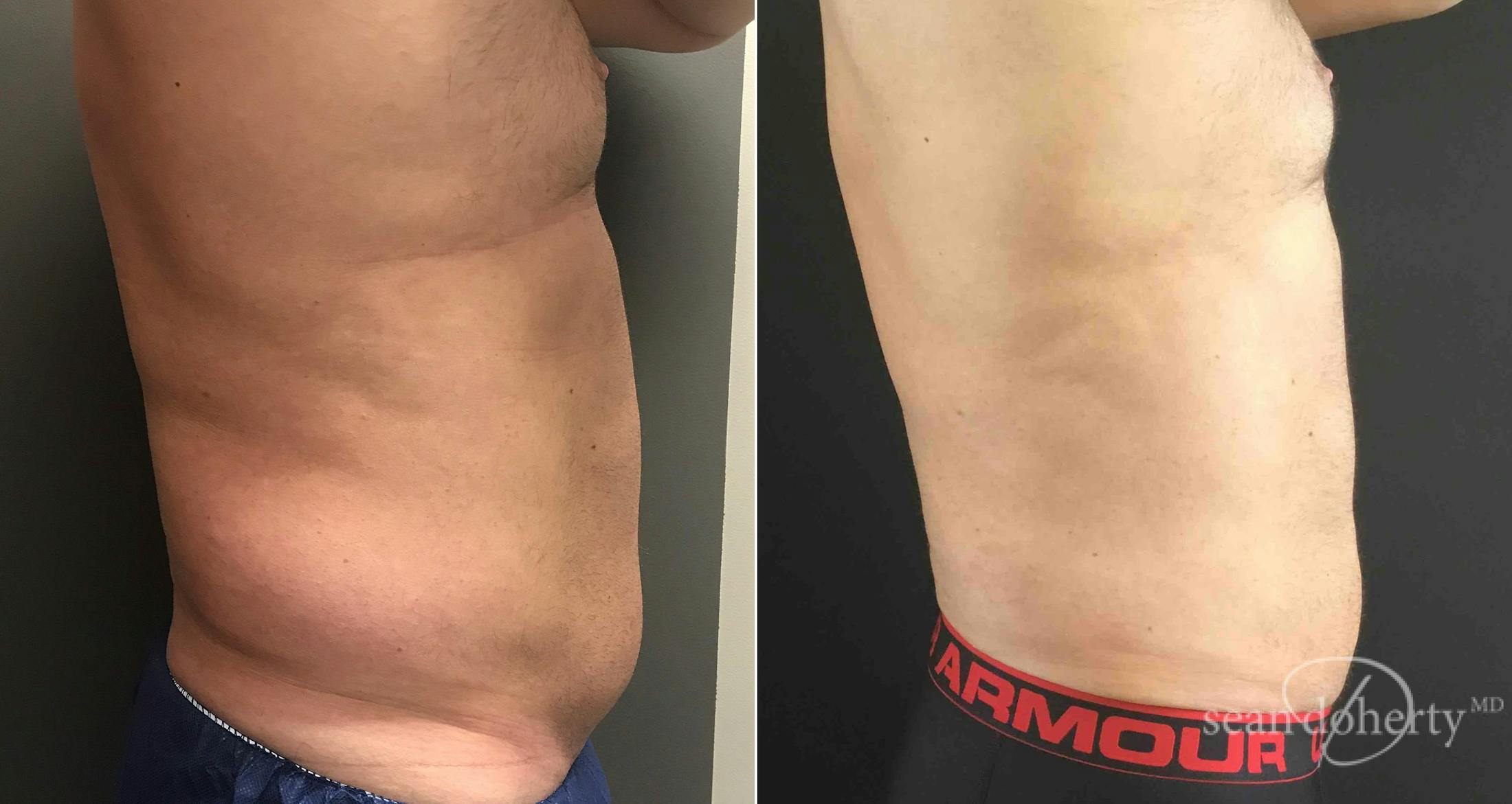 Liposuction and Fat Transfer Before & After Gallery - Patient 291161 - Image 3