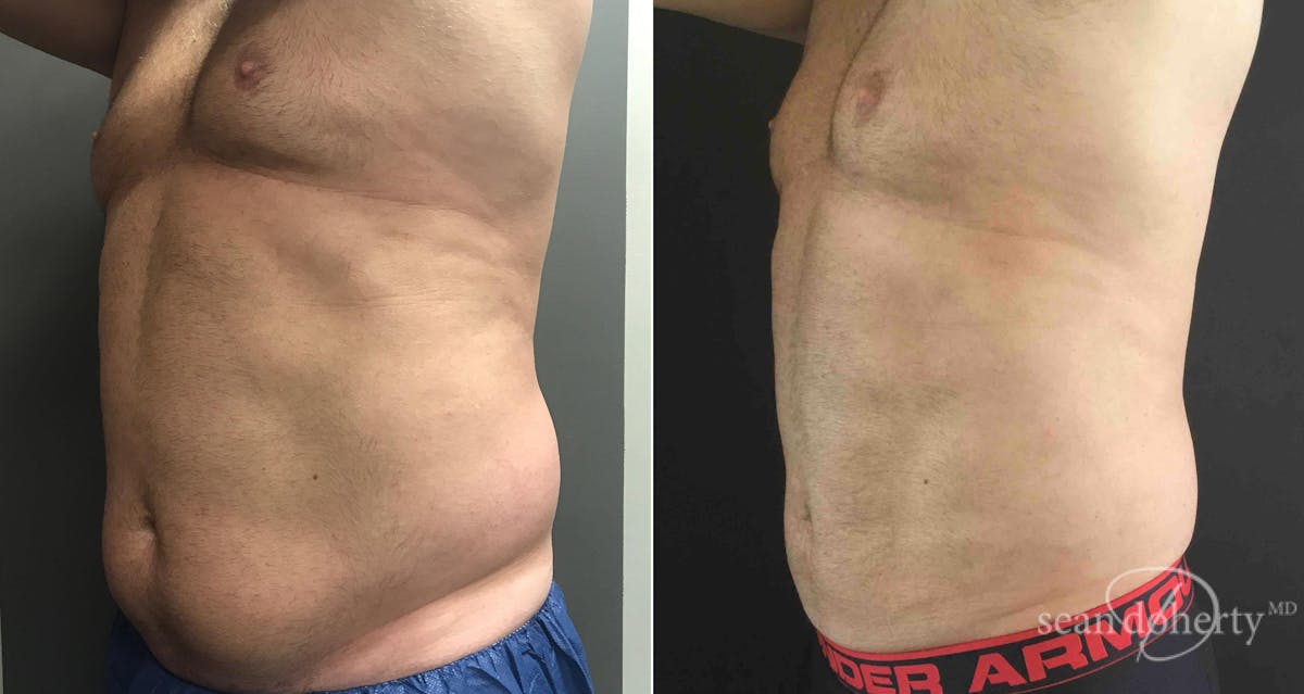 Liposuction and Fat Transfer Before & After Gallery - Patient 291161 - Image 2