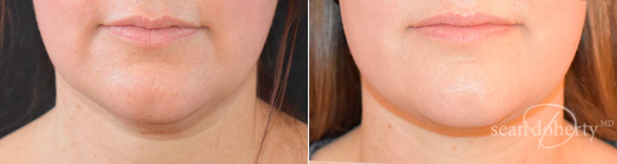 Liposuction and Fat Transfer Before & After Gallery - Patient 119616 - Image 1