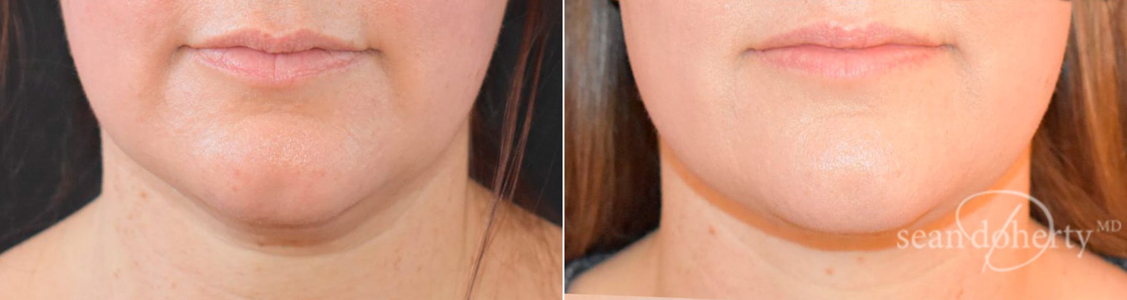 Liposuction and Fat Transfer Before & After Gallery - Patient 119616 - Image 1