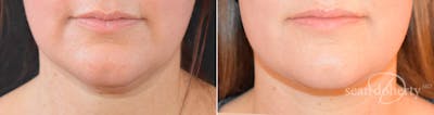 Liposuction and Fat Transfer Before & After Gallery - Patient 119616 - Image 1
