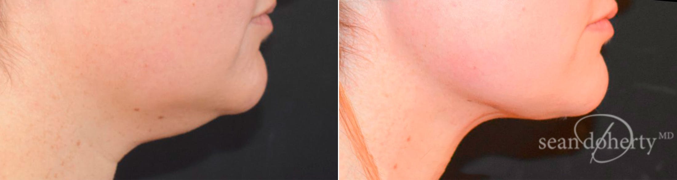Liposuction and Fat Transfer Before & After Gallery - Patient 119616 - Image 3