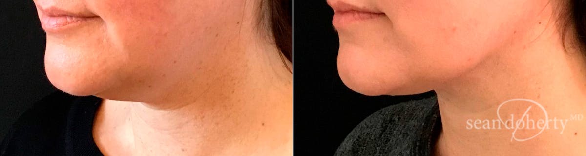 Liposuction and Fat Transfer Before & After Gallery - Patient 119616 - Image 2
