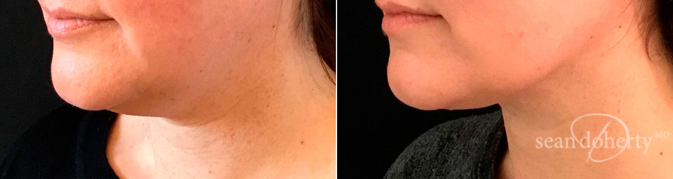 Liposuction and Fat Transfer Before & After Gallery - Patient 119616 - Image 2