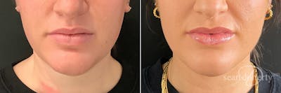 Liposuction and Fat Transfer Before & After Gallery - Patient 107482 - Image 1