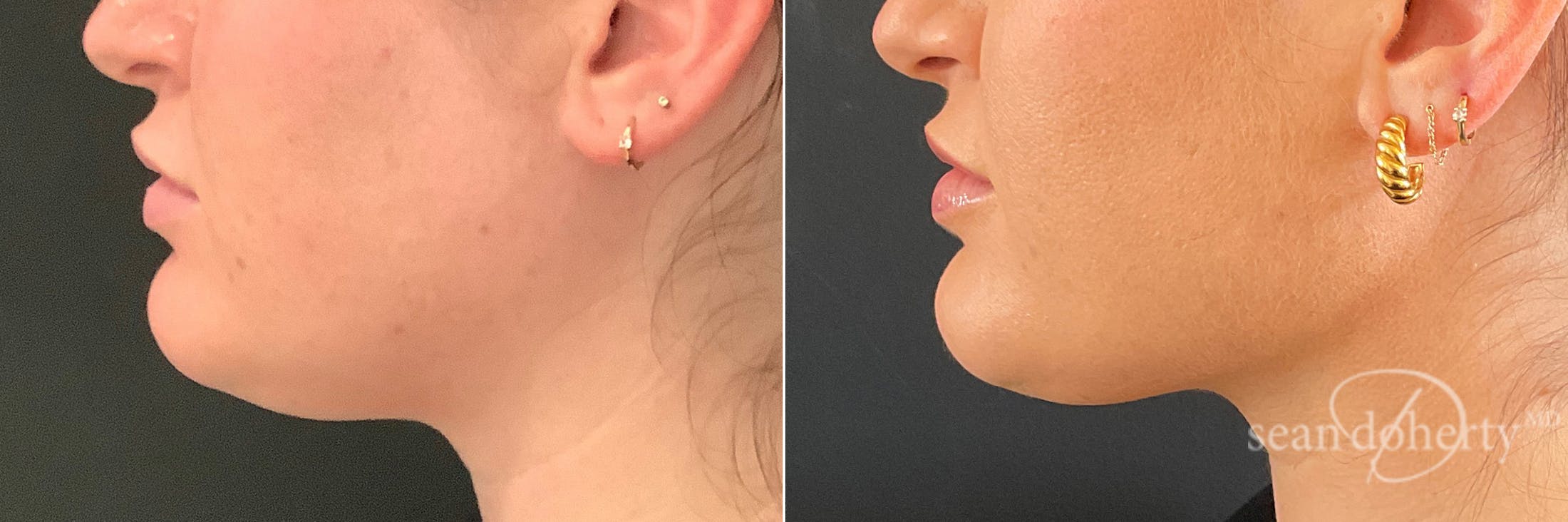 Liposuction and Fat Transfer Before & After Gallery - Patient 107482 - Image 3