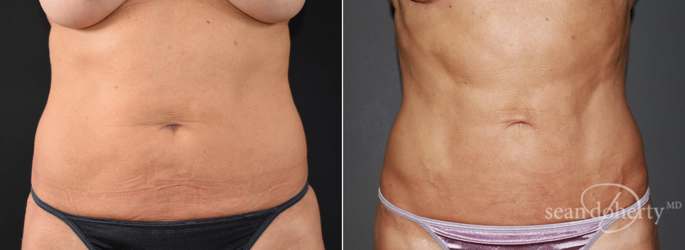 Liposuction and Fat Transfer Before & After Gallery - Patient 385890 - Image 1