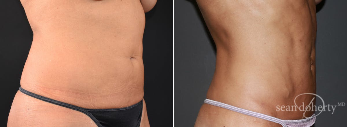 Liposuction and Fat Transfer Before & After Gallery - Patient 385890 - Image 2