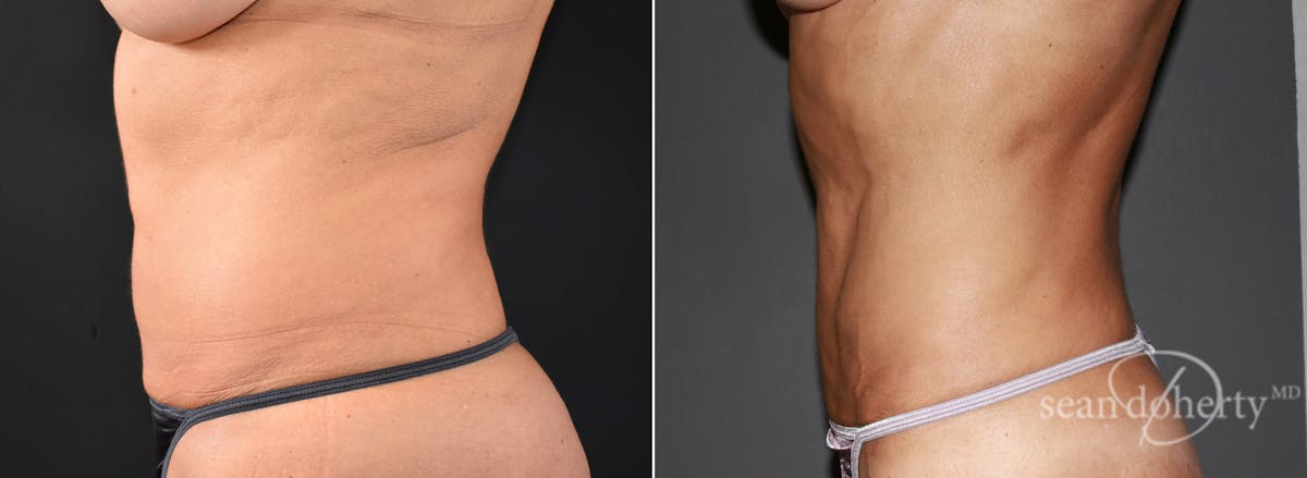 Liposuction and Fat Transfer Before & After Gallery - Patient 385890 - Image 3