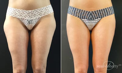 Liposuction and Fat Transfer Before & After Gallery - Patient 370674 - Image 1