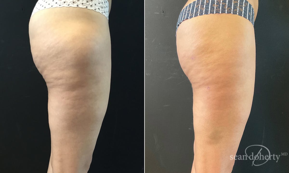 Liposuction and Fat Transfer Before & After Gallery - Patient 370674 - Image 4