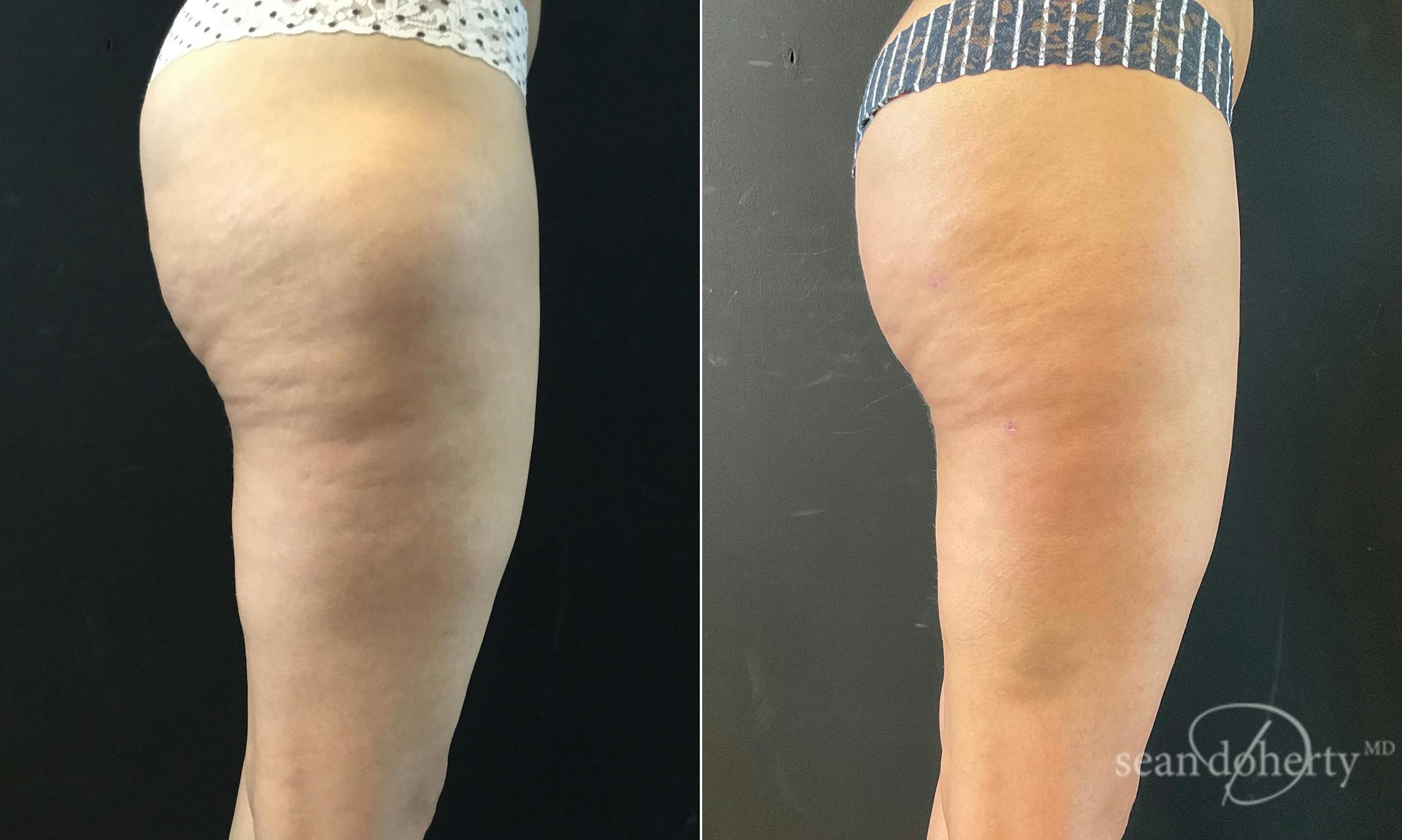 Liposuction and Fat Transfer Before & After Gallery - Patient 370674 - Image 4