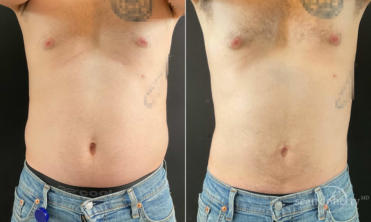 Liposuction and Fat Transfer Before & After Gallery - Patient 671594 - Image 1