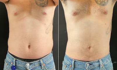 Liposuction and Fat Transfer Before & After Gallery - Patient 671594 - Image 1