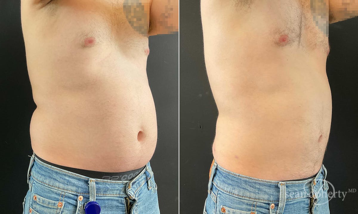 Liposuction and Fat Transfer Before & After Gallery - Patient 671594 - Image 2