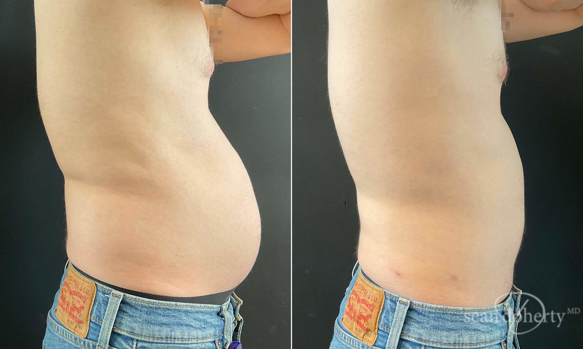 Liposuction and Fat Transfer Before & After Gallery - Patient 671594 - Image 3