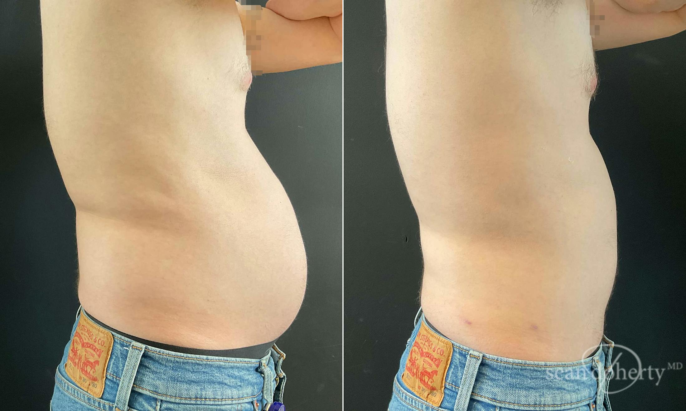 Liposuction and Fat Transfer Before & After Gallery - Patient 671594 - Image 3