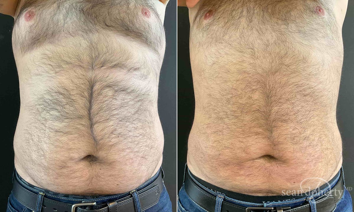 Liposuction and Fat Transfer Before & After Gallery - Patient 117251 - Image 1