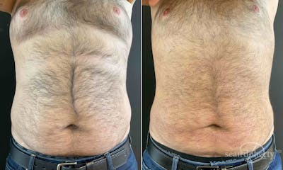Liposuction and Fat Transfer Before & After Gallery - Patient 117251 - Image 1