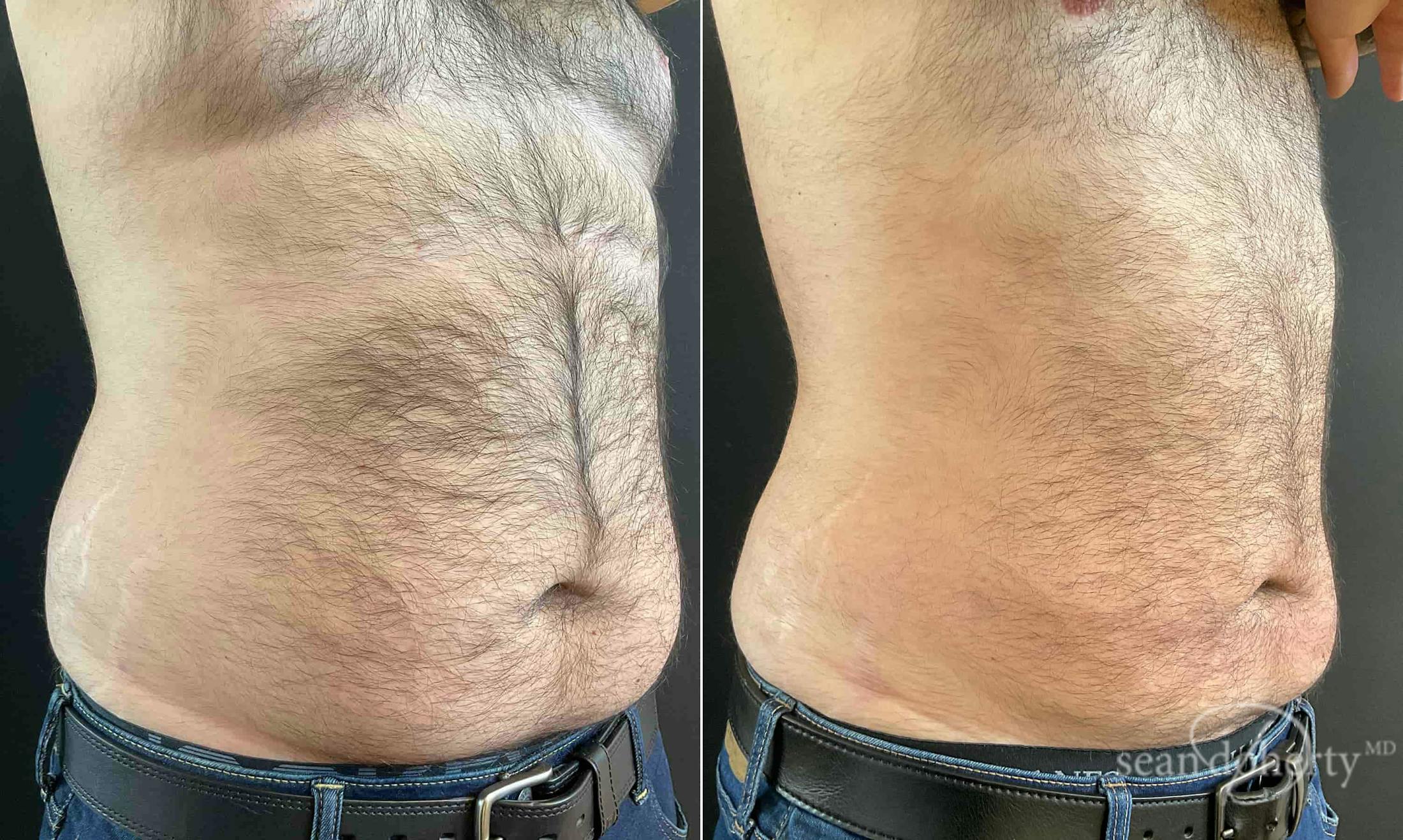 Liposuction and Fat Transfer Before & After Gallery - Patient 117251 - Image 2