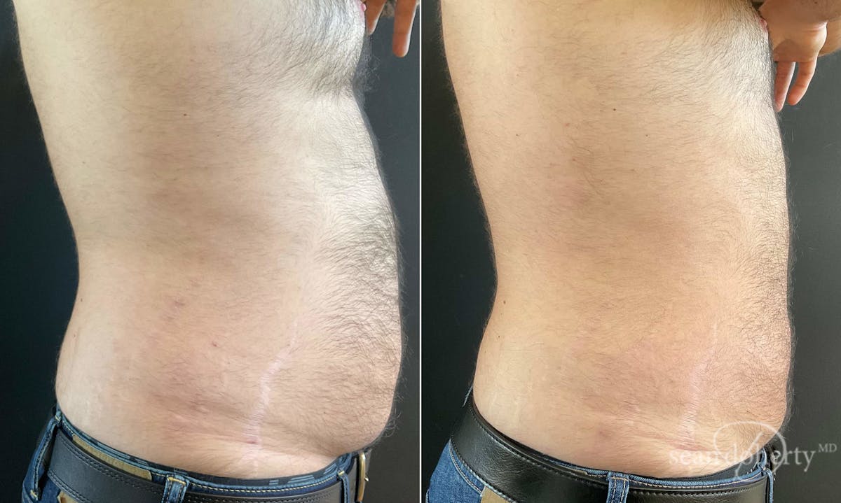 Liposuction and Fat Transfer Before & After Gallery - Patient 117251 - Image 3