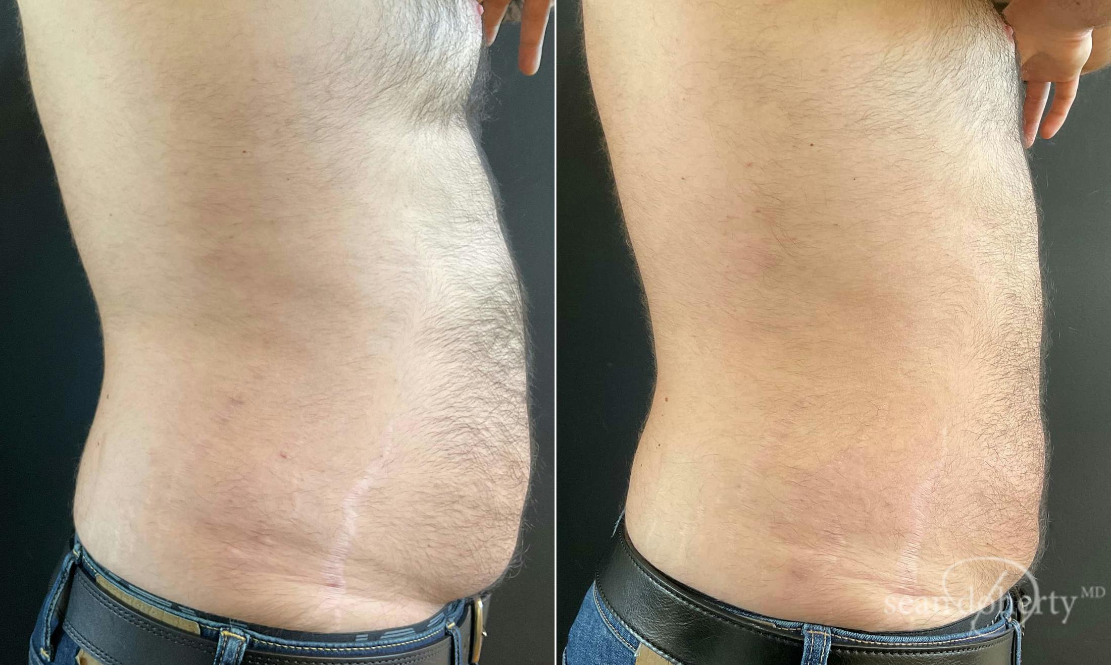Liposuction and Fat Transfer Before & After Gallery - Patient 117251 - Image 3