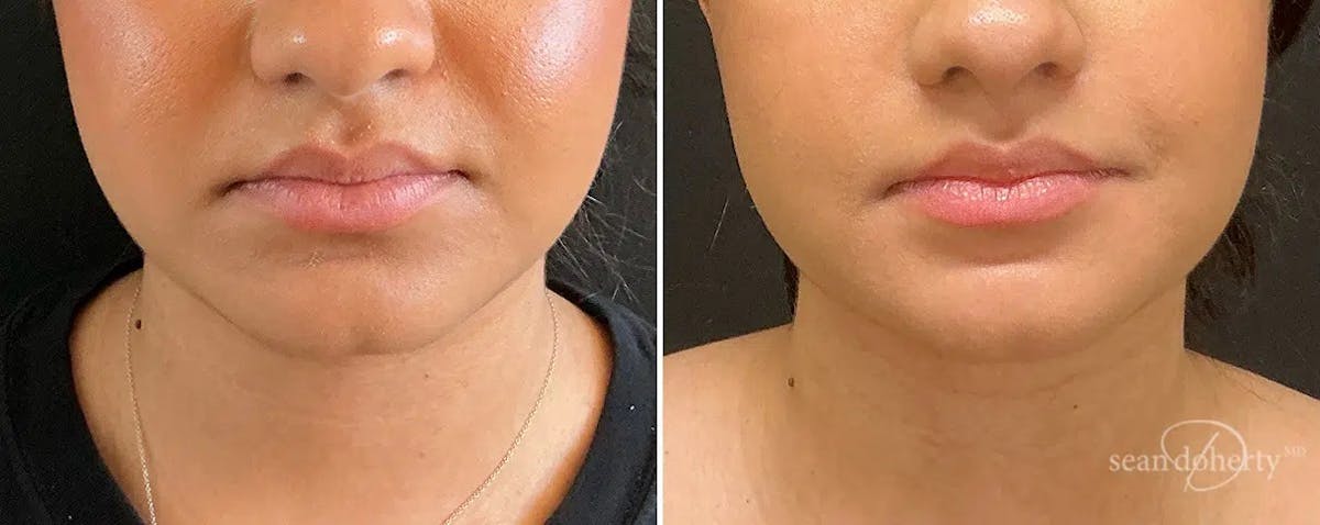 Liposuction and Fat Transfer Before & After Gallery - Patient 142248 - Image 3