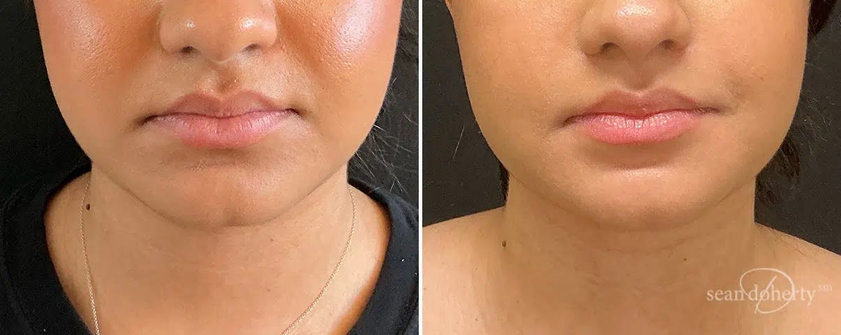 Liposuction and Fat Transfer Before & After Gallery - Patient 142248 - Image 3