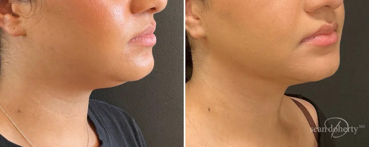 Liposuction and Fat Transfer Before & After Gallery - Patient 142248 - Image 2