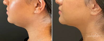 Liposuction and Fat Transfer Before & After Gallery - Patient 142248 - Image 1